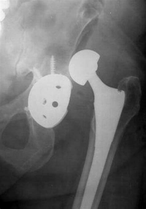 hip hemiarthroplasty orthobullets|THA Dislocation .